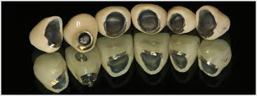 Протезирование зубов металлокерамикой в Симферополе